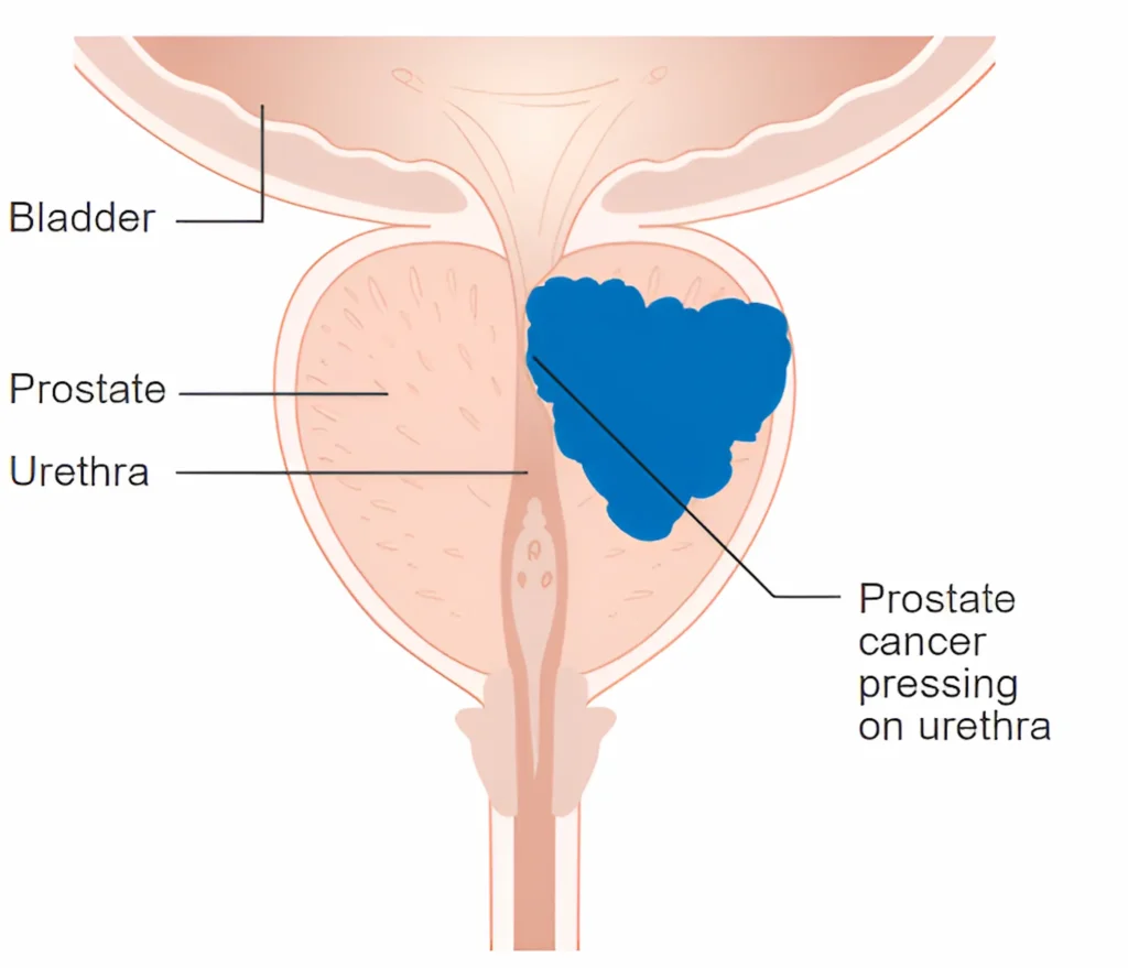Prostate Cancer